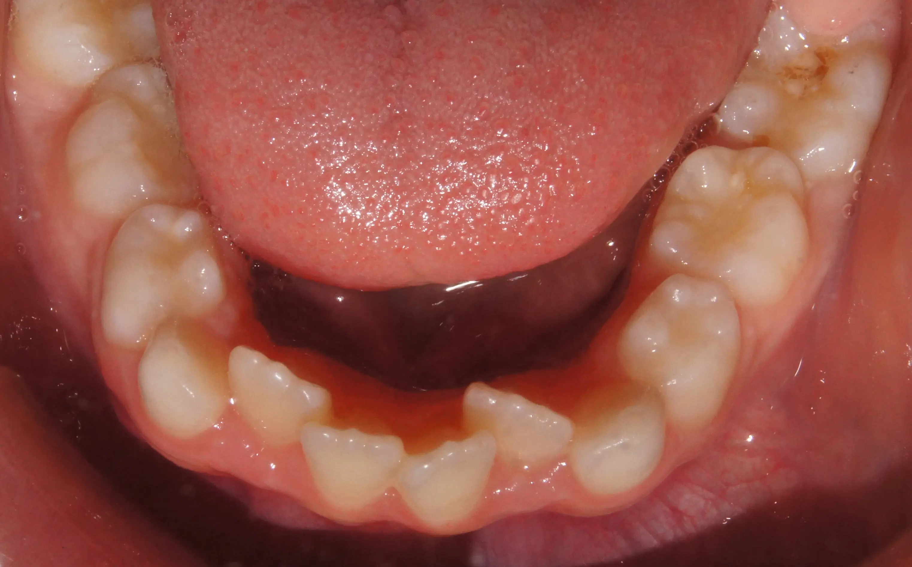 Early Crowding Harley Street Orthodontist London